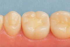 Tambal Composite Gigi Susu Di Coterie Clinic