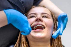 Pasang Behel Sapphire di Total Dental Care