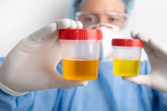 Pemeriksaan Urinalisa Protein urin di Emyu Healthcare