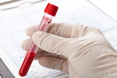 Pemeriksaan Lemak Lipoprotein (a) di C-Lab