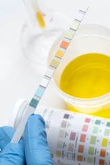 Pemeriksaan Urinalisa Urine Rutin/Lengkap (pH, Berat Jenis,Sedimen,Albumin,Bilirubin,Urobilin,Urobili nogen,Keton,Nitrit) di C-Lab