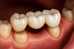 Crown & Bridge di NUI Dental Studio