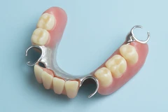 Pemasangan Gigi Palsu Lepasan - Metal di NUI Dental Studio