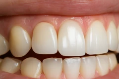 Teeth Whitening di Bogor Dental Center Warung Jambu