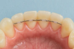 Direct fixed retainer per rahang di Beloved Dental Care