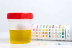 Pemeriksaan Urin Rutin di Klinik Edelweiss