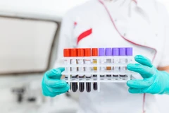 Screening Hepatitis di Klinik Tiara Bunda