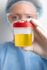 Pemeriksaan Mikroalbumin Urine Sewaktu di ScanMe Labs