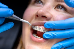 Pasang Behel Metal USA oleh drg. Umum di Indonesia Clinic & Dental