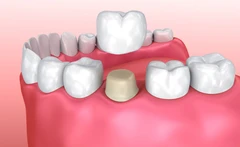Paket Crown PFM (Per Gigi/Abutment) di NK Health