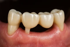 Paket Crown Ceramic/Zircon (Spesialis) (Per Gigi/Abutment) di NK Health