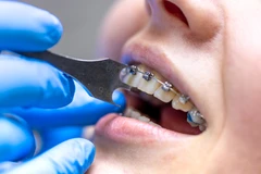 Pasang Behel Metal Roth di NK Health