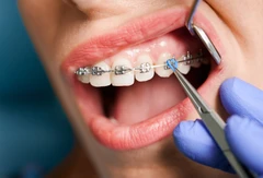 Pasang Behel Metal Self-Ligating di NK Health