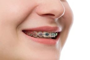 Pasang Behel Metal oleh drg. Umum di Praktik drg. Putri Linda Sari
