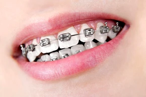 Pasang Behel Metal Konvensional oleh drg. Spesialis Ortodontik di Wide Smile Dental Clinic