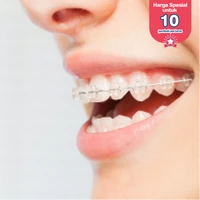 Pemasangan Behel Self Ligating Clear Damon oleh Dokter Gigi Spesialis Ortodonti di Klinik Tooth Signature