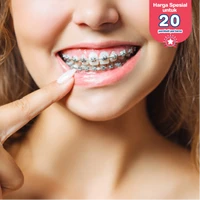 Pasang Behel Metal oleh drg. Umum + Scaling di FD Care