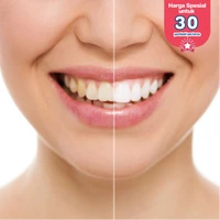 Bleaching Gigi di Klinik Gigi drg. Mia