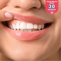 Bleaching Gigi dengan LED + Scaling Gigi + Polishing + Topical Fluoride di DENTALMATE DENTALCARE