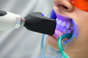 Bleaching Gigi di TruSmile Dental House