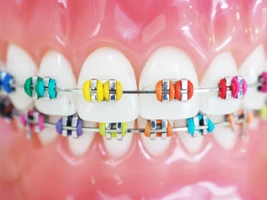 Pasang Behel Metal Anak 1 Rahang di Klinik Gigi Ammyn Sukabumi