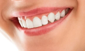 Bleaching Gigi Internal untuk 1 Gigi di CS Dental