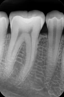 Periapikal Xray Digital Di Coterie Clinic