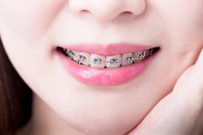 Pemasangan Behel Metal oleh drg. Spesialis Ortodontis di Airis Dental Clinic