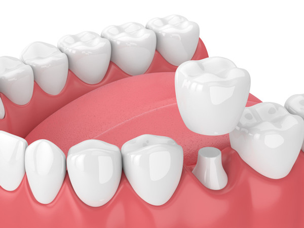 Crown Porcelain Fused to Metal (PFM) di Primera Dental | HDmall
