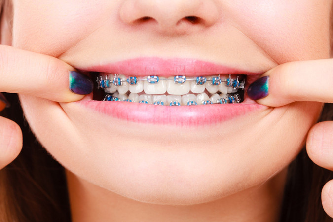 Pemasangan Behel Metal oleh drg. Spesialis Ortodontis di Alea Dental