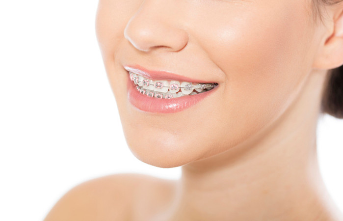 Pasang Behel Metal oleh drg. Umum di Dentaline dental care