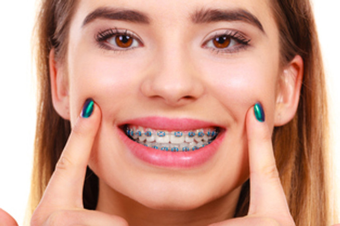 Pasang Behel Metal oleh drg. Spesialis Ortodontik di Fidental Clinic