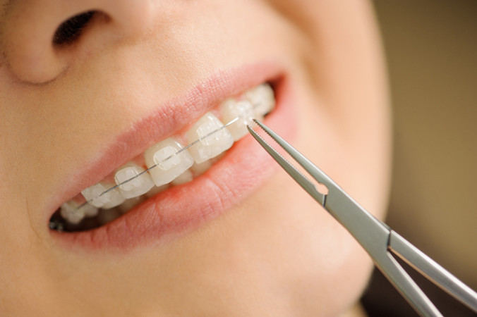 Pemasangan Behel Keramik oleh drg. Umum di Embun Galaxi Dental Care