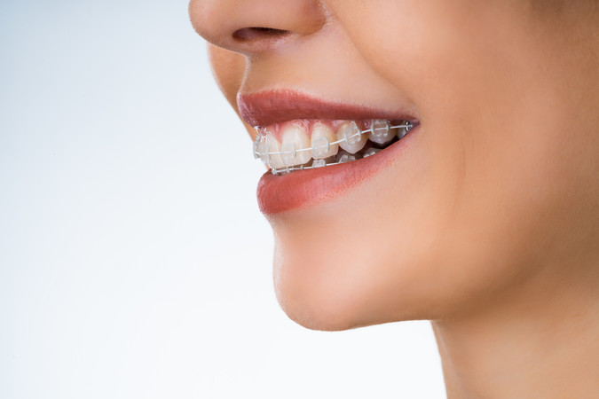 Pemasangan Behel Self Ligating Clear oleh drg. Umum di Klinik Prismadent