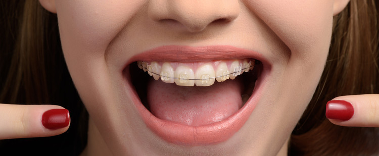 Pemasangan Behel Self Ligating Easy Clip USA oleh drg. Umum di A+ Dental Care