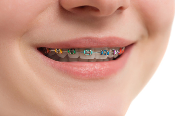 Pasang Behel Metal oleh drg. Umum di Pearl Dental