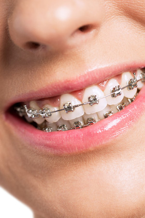 Pemasangan Behel Self Ligating Damon Quantum oleh drg. Spesialis Ortodonti di Alea Dental
