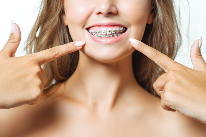 Pemasangan Behel Self Ligating Damon Metal di Dentaline dental care