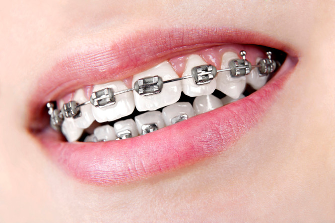 Pemasangan Behel Self Ligating Damon Metal oleh drg. Spesialis Ortodontis di Akatara Clinic