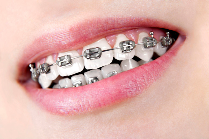 Pemasangan Behel Self Ligating Metal oleh drg. Umum + Scaling Gigi di FD Care