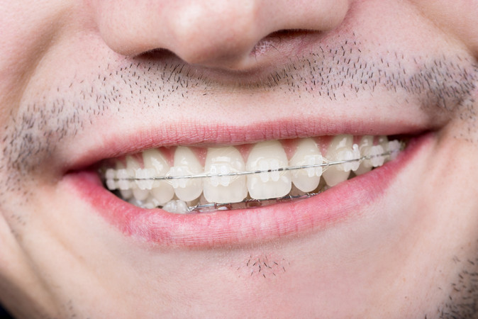 Pemasangan Behel Keramik di Champion Dental Care