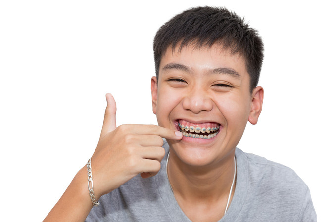 Pemasangan Behel Metal (Kasus Gigi Sederhana) oleh drg. Umum + Cetak Gigi + Scaling Gigi di Upstairs Dental Clinic