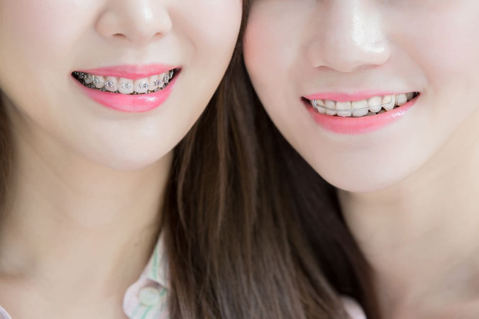 Pasang Behel Metal oleh drg. Umum di Schon Dental