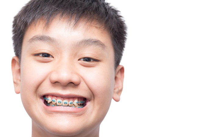 Pemasangan Behel Metal oleh drg. Umum di Klinik Gigi Dewi