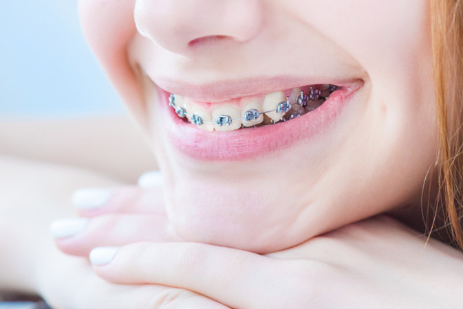 Pemasangan Behel Metal oleh drg. Umum + Cetak Gigi + Scaling Gigi di AM Dental Care