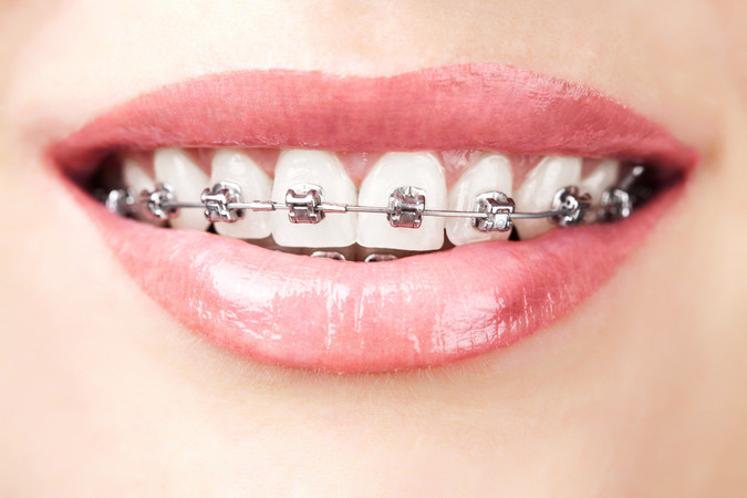 Pemasangan Behel Metal oleh drg. Umum di Smile Up! Dental Clinic
