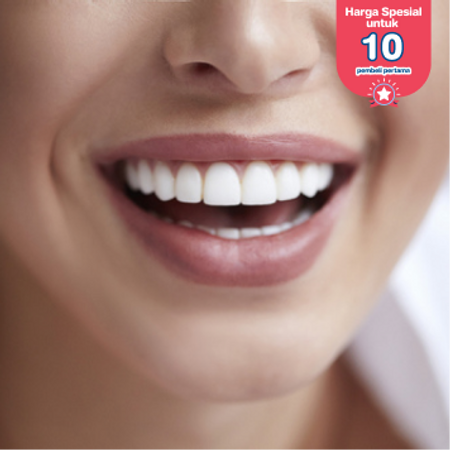 Direct Veneer Composite 8 Gigi di Fre Dental Care