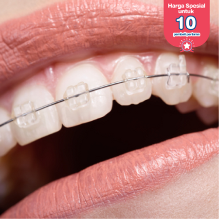 Pemasangan Behel Keramik + Scaling Gigi di Fre Dental Care