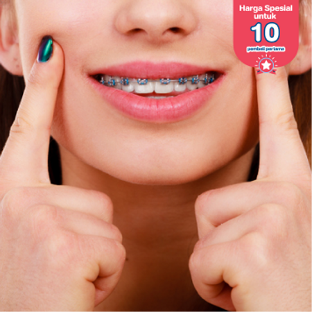 Pasang Behel Metal oleh drg. Umum di My Dental Studio