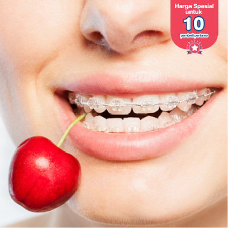 Pemasangan Behel Sapphire oleh drg. Umum di My Dental Studio
